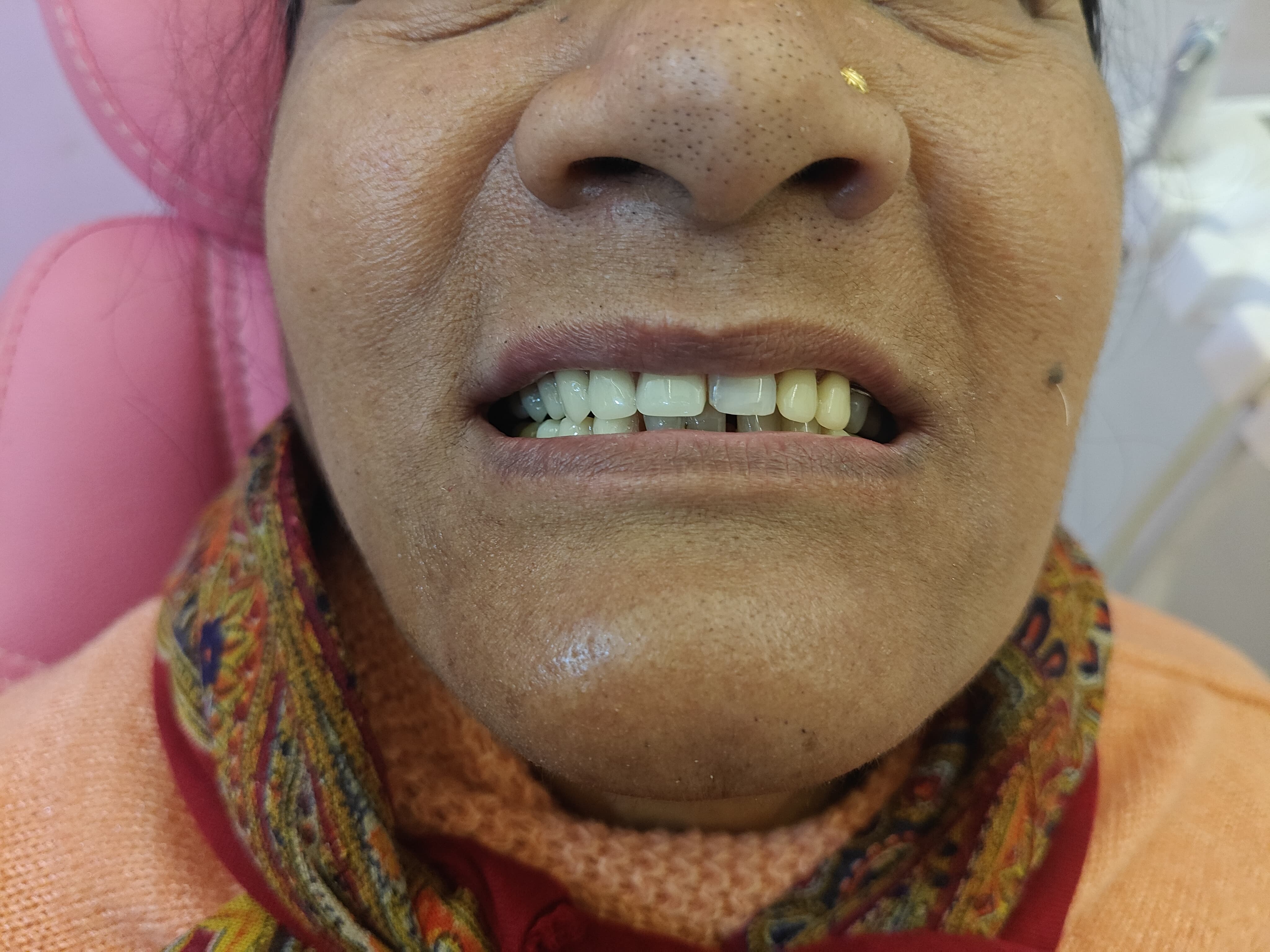 Smile Transformation Case 12